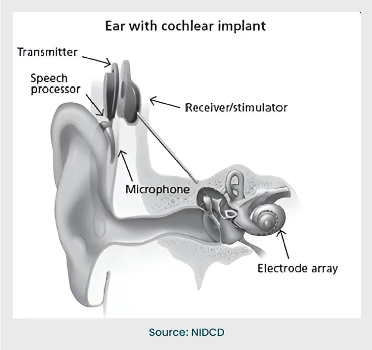Cochlear-implant speech-coding hardware, associated with inventor Blake Wilson