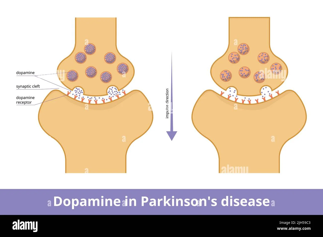Implanted dopamine dosing-pump system for Parkinson's disease, associated with inventor Caroline Moreau