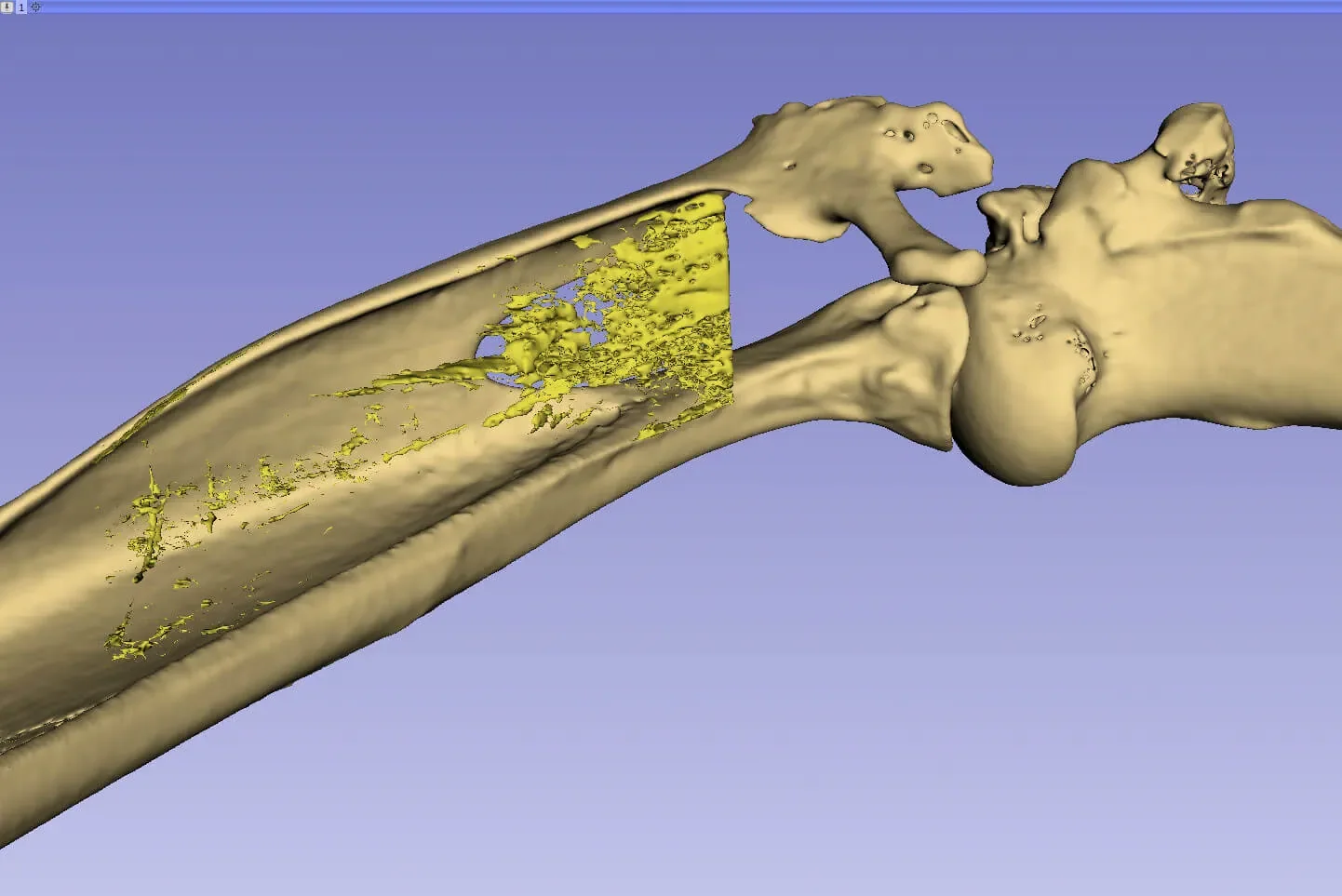 STR GRAFT biodegradable rotator-cuff scaffold, associated with inventor Cato T. Laurencin