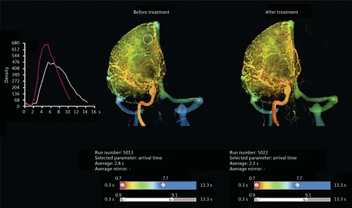 Real-time angiographic imaging technologies, associated with inventor Charles A. Mistretta