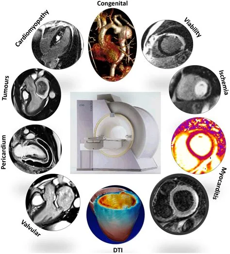 Spiral magnetic-resonance-imaging technology, associated with inventor Craig H. Meyer