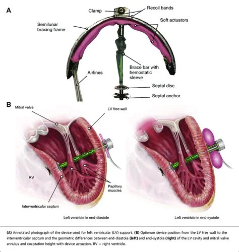 Soft robotic ventricular-assist sleeve, associated with inventor Ellen Roche