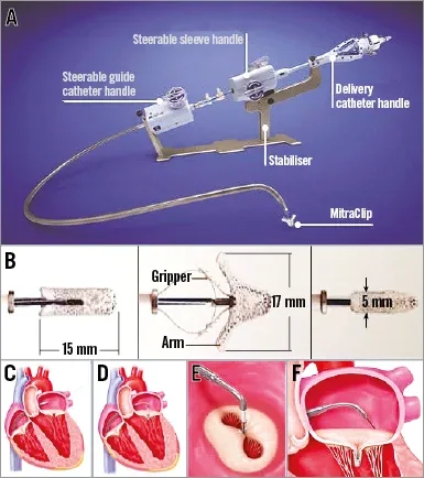 MitraClip transcatheter mitral-valve repair device, associated with inventor Fred St. Goar