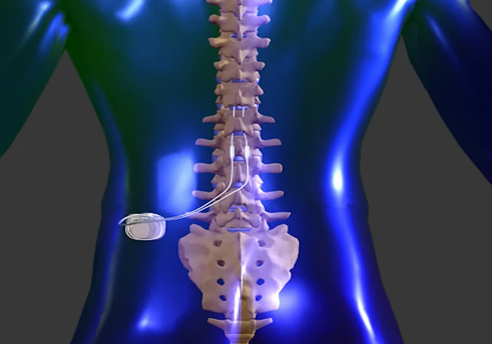 Cochlear implants, spinal-cord stimulators, pacemakers, and RFID biochips, associated with inventor Gerald E. Loeb