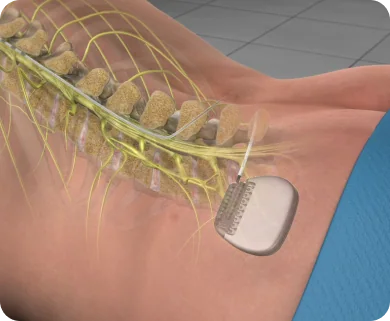 Electronic spinal-stimulation implant, associated with inventor Grégoire Courtine