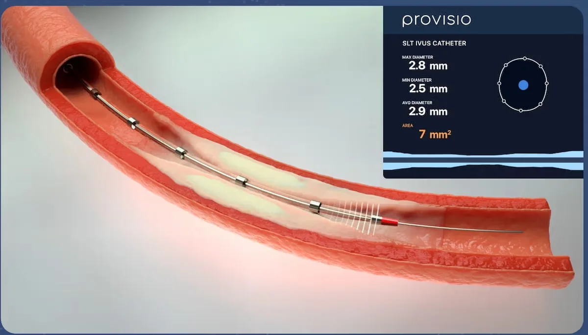 Catheter-based and molecular ultrasound-imaging systems, associated with inventor John A. Hossack