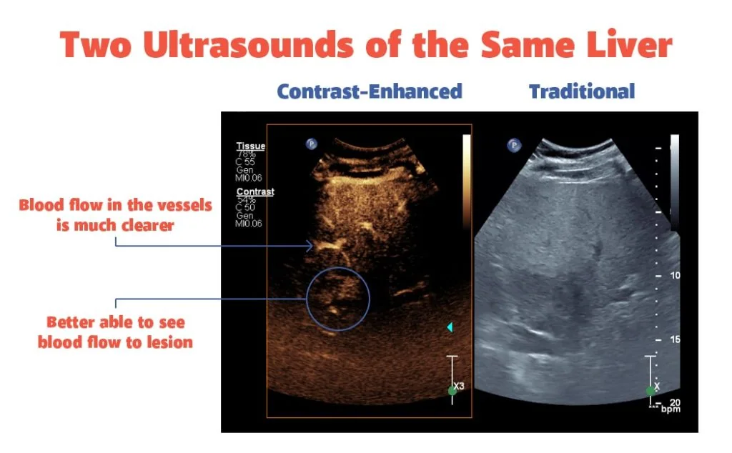 Bioengineered blood-vessel patches and ultrasound contrast agents, associated with inventor Joyce Y. Wong