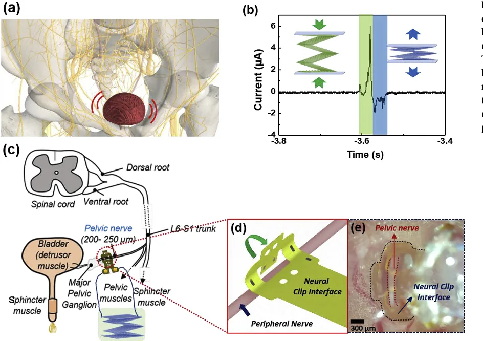 NeuroClip pelvic-nerve neuromodulation implant, associated with inventor Mario Romero-Ortega