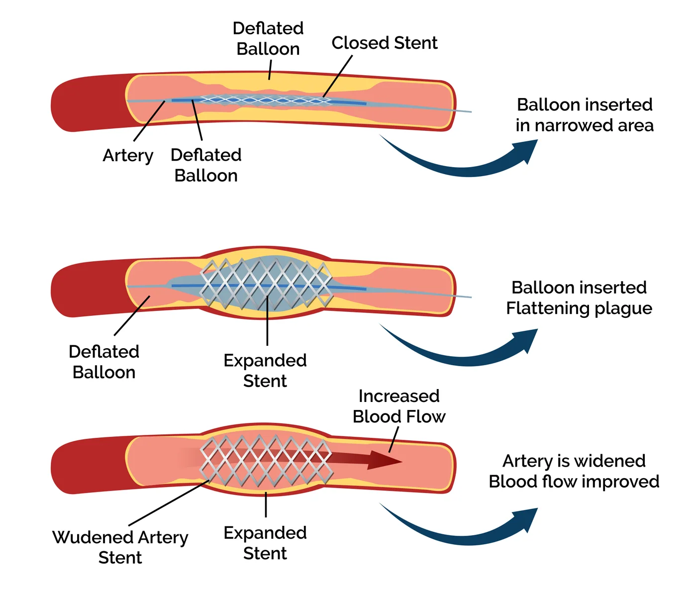 Rapid Exchange balloon angioplasty and stenting system, associated with inventor Paul G. Yock