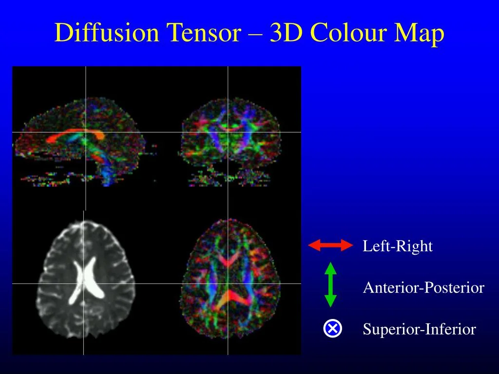 Diffusion tensor MRI and MRI tractography, associated with inventor Peter J. Basser