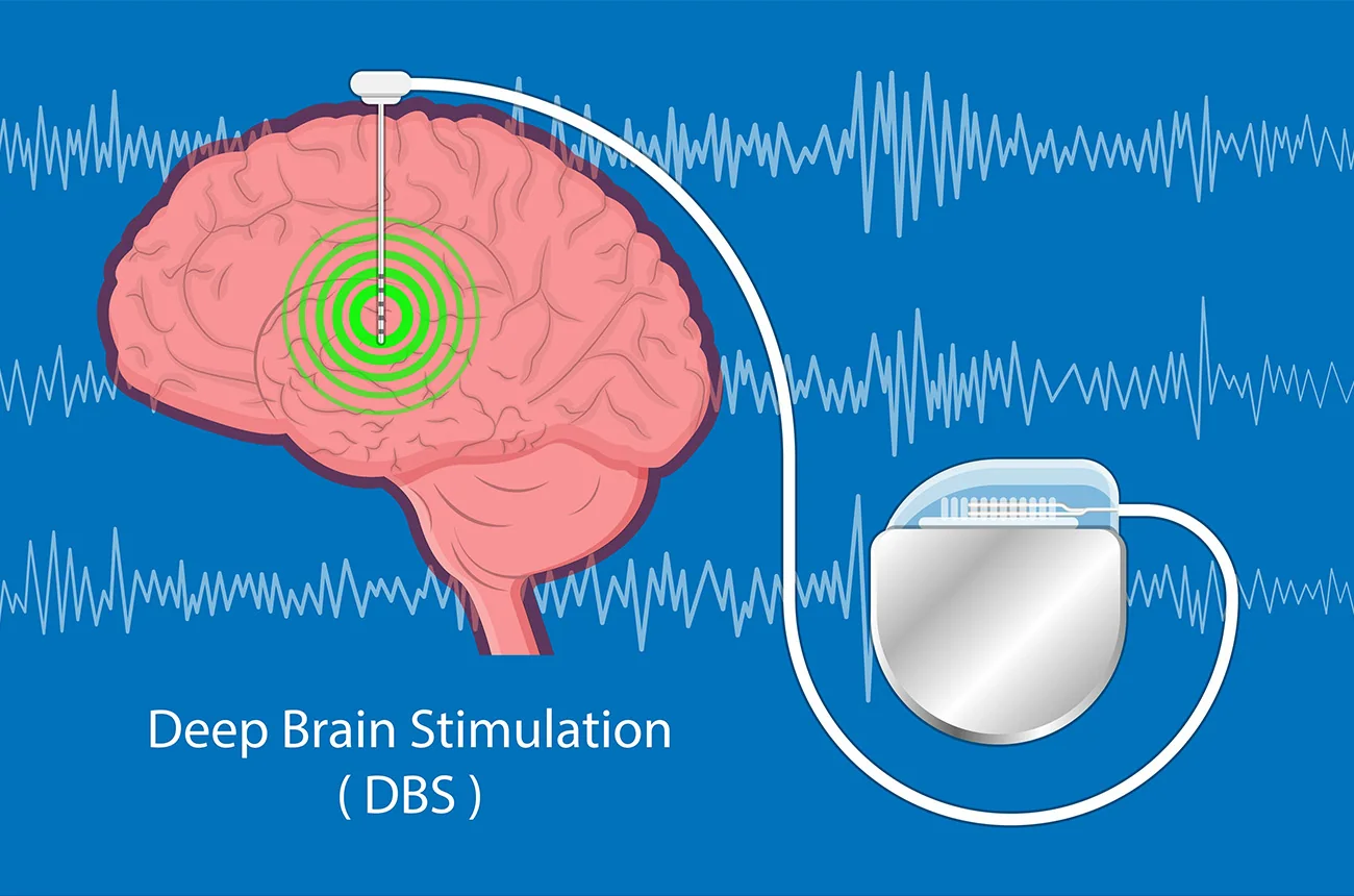 Programmable deep-brain stimulation system, associated with inventor Pierre Pollak