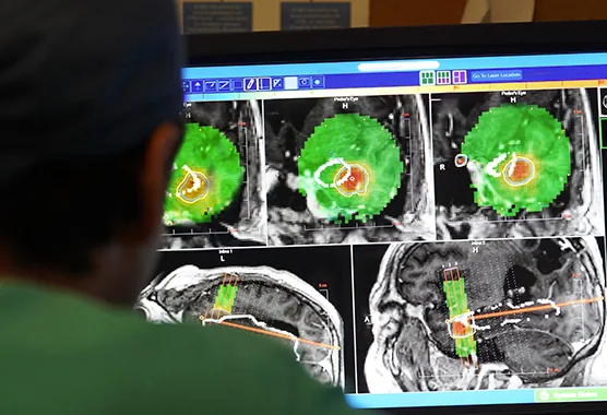 Tumor Monorail brain-tumor device, associated with inventor Ravi V. Bellamkonda