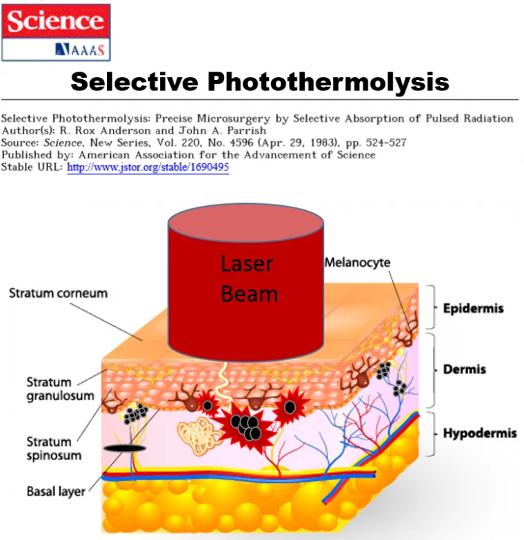 Selective-photothermolysis laser treatment device, associated with inventor Rox Anderson