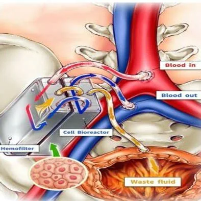 Implantable bioartificial kidney, associated with inventor Shuvo Roy