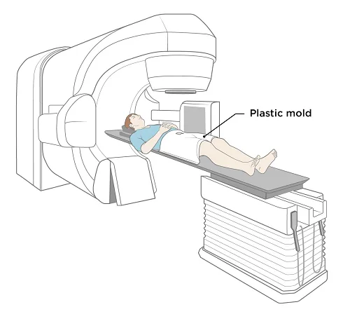 Image-guided intensity-modulated radiotherapy (tomotherapy) systems, associated with inventor Thomas R. Mackie
