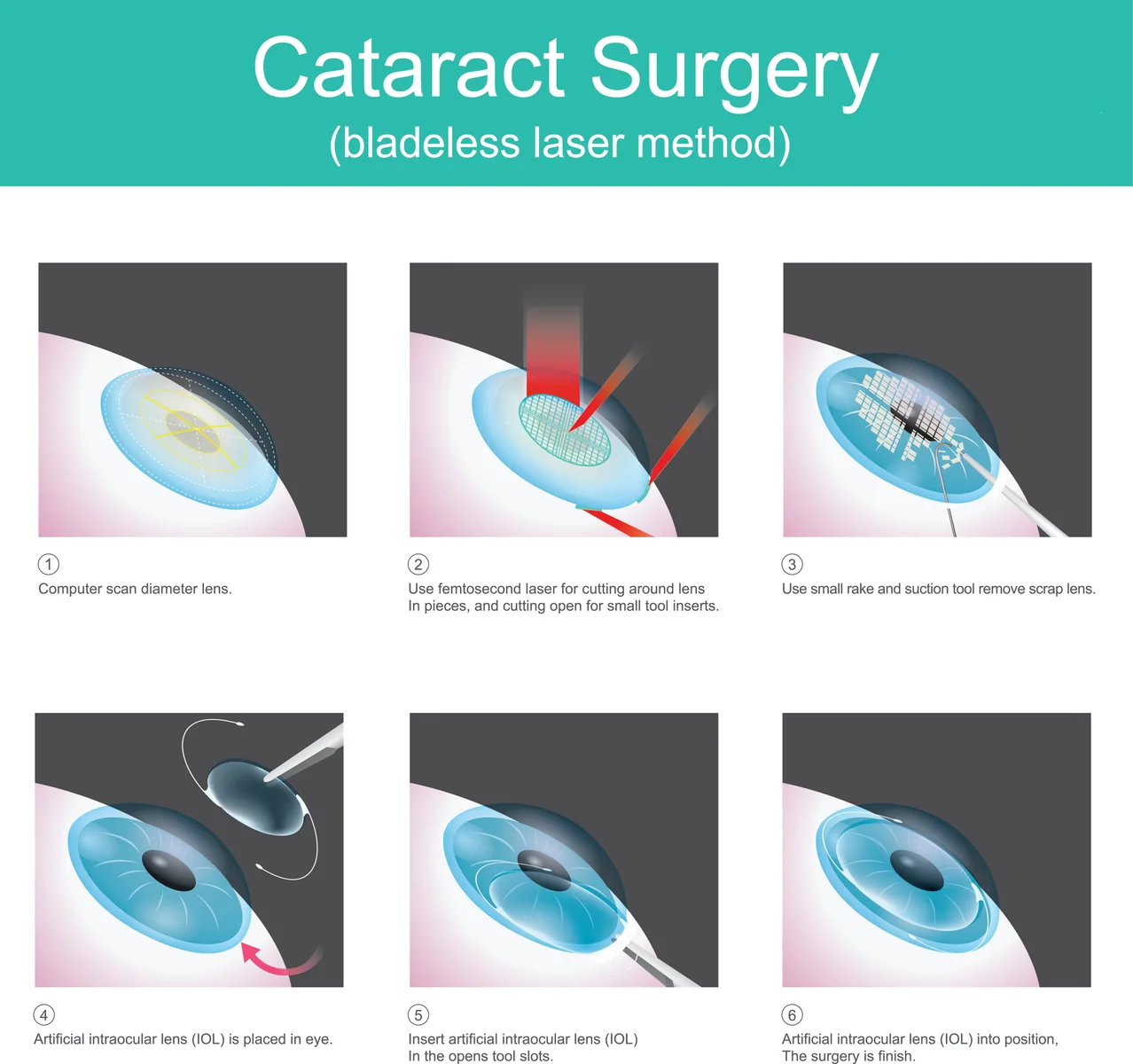 clinical femtosecond-laser systems for refractive and cataract surgery, associated with inventor Tibor Juhasz