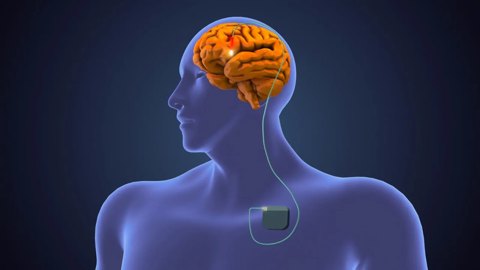 Targeted nerve-stimulation and deep-brain-stimulation devices, associated with inventor Warren M. Grill